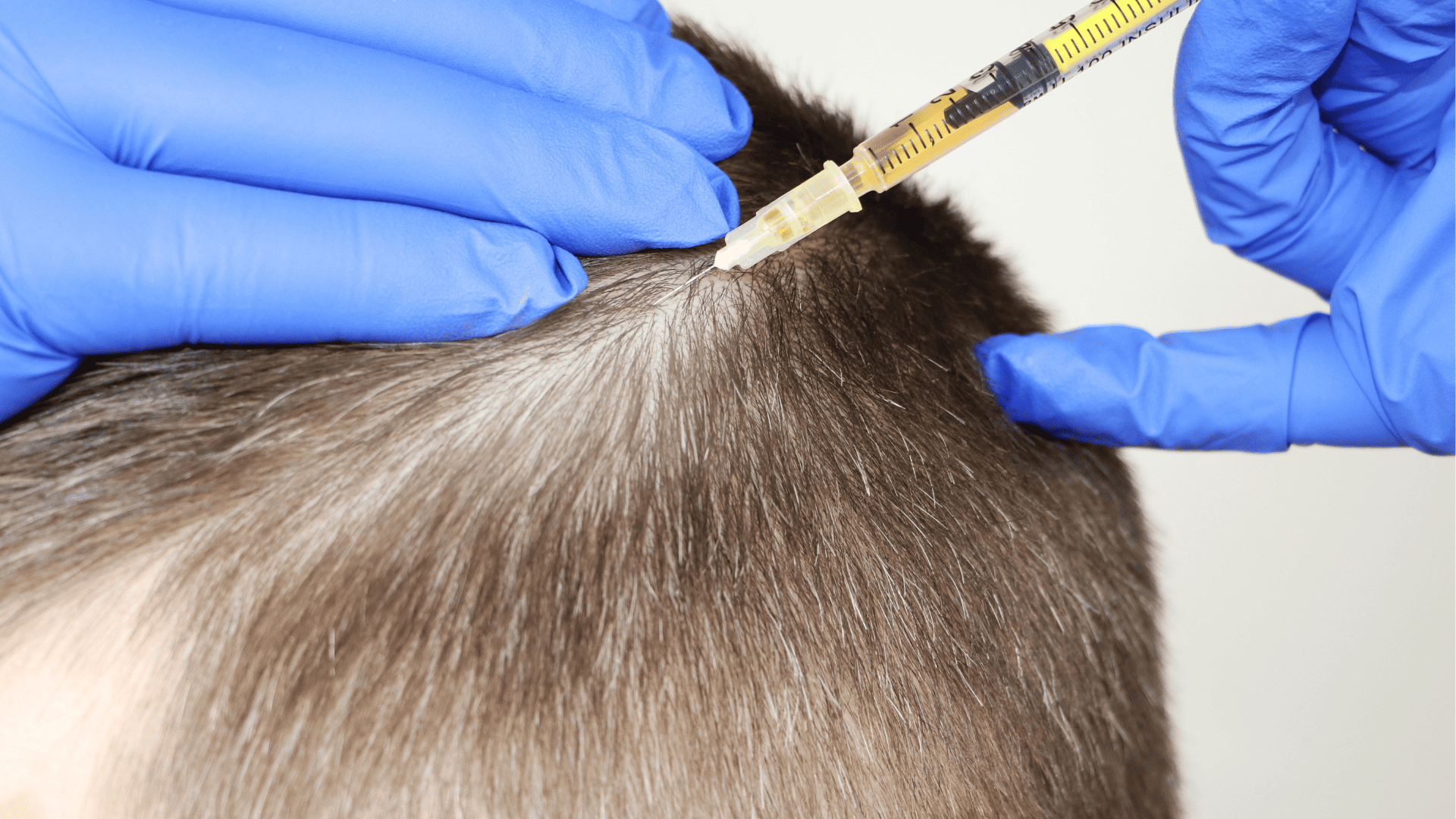 zabieg trychologiczny polegający na podaniu substancji aktywnych bezpośrednio w skórę głowy metodą mezoterapii