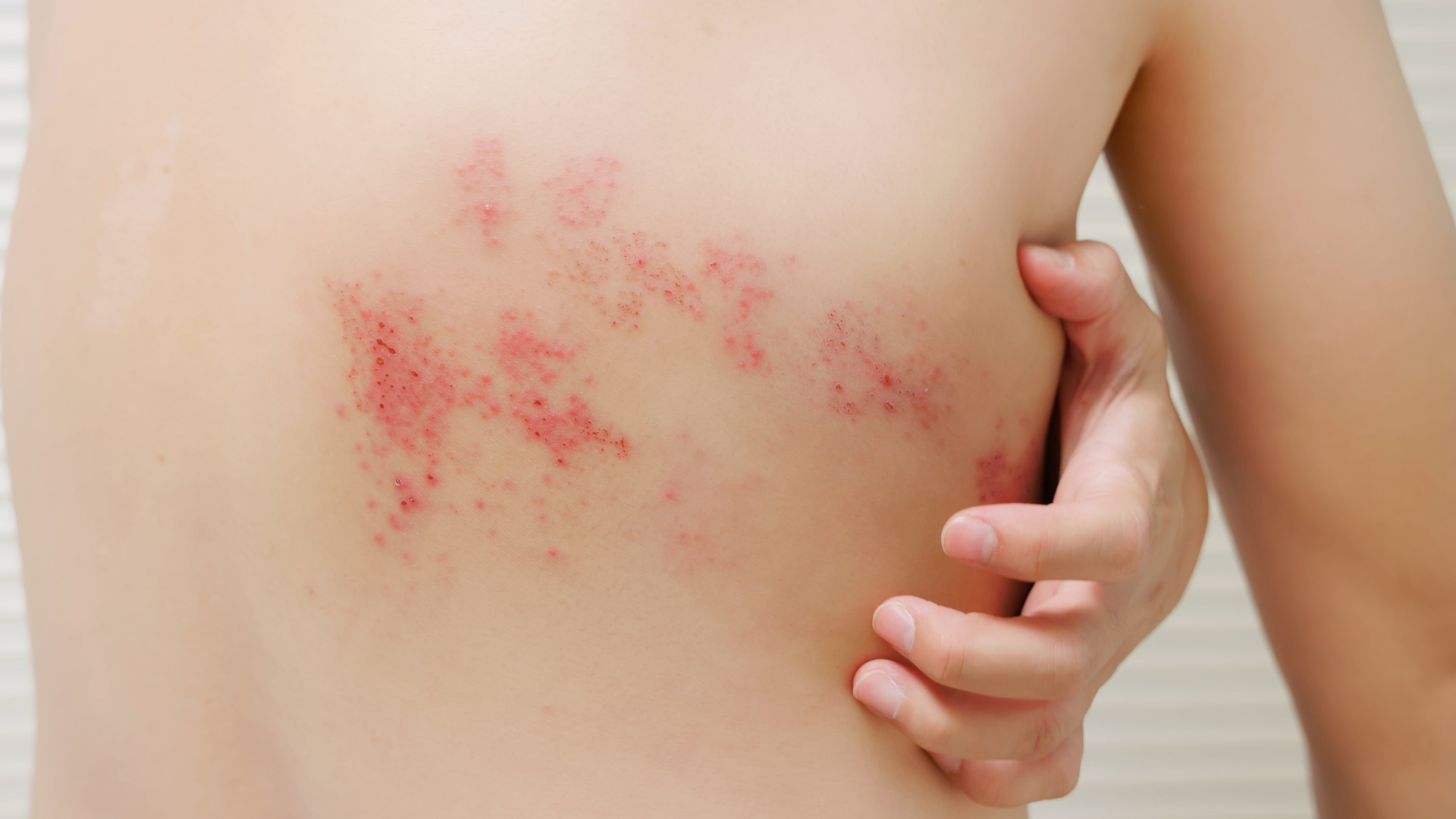 Półpasiec - objawy, przyczyny, powikłania i leczenie