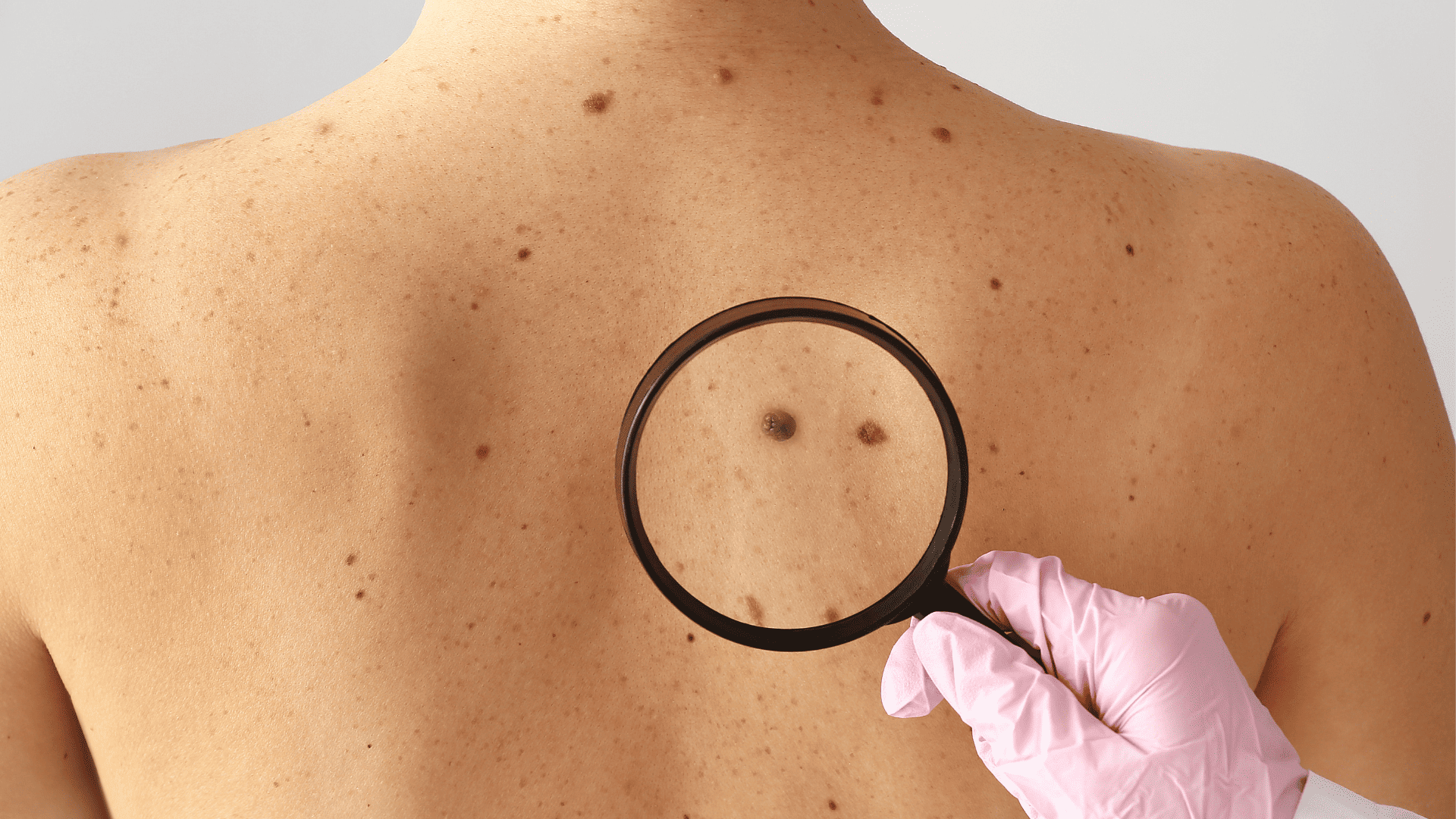 Dermatoskop przyłożony do zmiany skórnej na plecach pacjenta podczas badania dermatologicznego